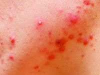 Kiła naczyniowo-oponowa u~chorego zakażonego HIV