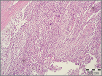 Opis przypadku fibroblastoma desmoplasticum u młodego mężczyzny