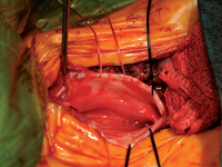 Całkowity rozszczep tchawiczo-przełykowy - prezentacja przypadku