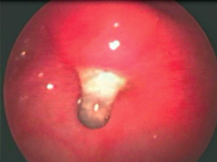 Ciało obce przełyku i żołądka -- nietypowy przebieg kliniczny