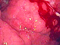 Zaawansowany nowotwór żołądka leczony chirurgicznie z istotnymi powikłaniami
