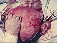 Rzadko spotykany przypadek olbrzymiego mięśniaka macicy