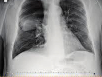 Jatrogenne ciała obce w jamie brzusznej - problemy medyczno-prawne