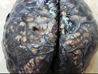 Narkolepsja u 37-letniej kobiety