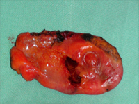 Izolowana perforacja pęcherzyka żółciowego w wyniku tępego urazu jamy brzusznej: wyzwanie diagnostyczne