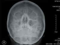 Różnorodność manifestacji klinicznych ziarniniakowatości Wegenera jako przyczyna trudności w prawidłowym rozpoznawaniu choroby