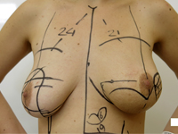 Mastektomia i jednoczasowa rekonstrukcja piersi u chorej na mięsaka gruczołu po przebytym skojarzonym leczeniu oszczędzającym z powodu raka