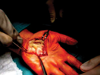 Izolowany nerwiakowłókniak splotowy ręki: opis dwóch przypadków. Propozycje diagnostyki i leczenia.