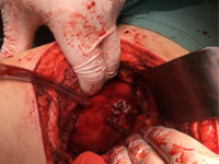 Zespół
 Wunderlicha objawiający się samoistnym krwotokiem nerkowym
   w jamie zaotrzewnowej jako pierwsza manifestacja raka
  nerkowokomórkowego