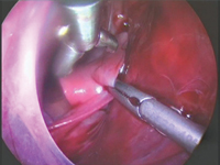 Jednostronna hipoplazja płuca ze szczątkową jamą opłucnową w torakoskopii - problemy diagnostyczne