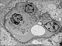 Ostre kłębuszkowe zapalenie nerek u dziewczynki z rodzinnym zespołem Alporta - opis przypadku