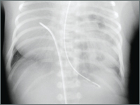 Nietypowy przypadek wrodzonej przepukliny przeponowej prawdziwej