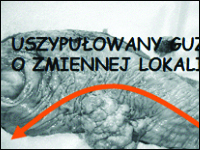 Zmienna lokalizacja gruczolakoraka odbytnicy: wpływ opisu badania na wybór zabiegu operacyjnego