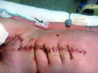 Wstrząs hipowolemiczny powikłany ostrą niewydolnością nerek. Użycie technik ciągłych nerkozastępczych