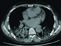 Zapalenie płuc z ostrą niewydolnością oddechową u pacjenta po przeszczepieniu nerki - etiologiczne trudności diagnostyczne