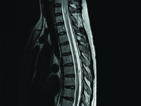 Kontrowersje dotyczące istnienia łagodnej formy choroby Devica - opis przypadku
