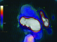 Nietypowy obraz gruźlicy płuc u chorej z przewlekłą niewydolnością nerek, po transplantacji nerki