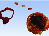 Ostra obturacyjna zakrzepica zastawki mechanicznej w pozycji mitralnej - wciąż aktualne powikłanie