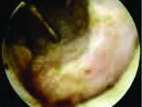 Powikłania septyczne po operacyjnym nacięciu szyi pęcherza moczowego (TUNI) u biorcy nerki z wieloletnią cukrzycą typu 1