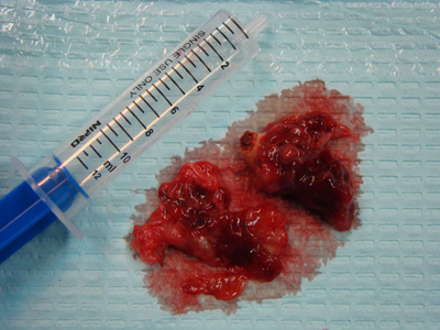 Śluzak lewego przedsionka u pacjenta z wrodzoną anomalią tętnic wieńcowych