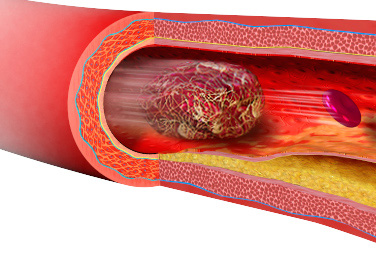 Udar niedokrwienny mózgu spowodowany zatorem płynem owodniowym - opis przypadku