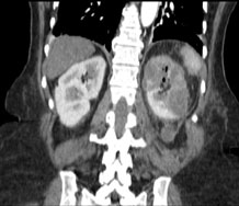 Przypadek ephysematosus pyelonephritis u pacjentki z cukrzycą