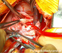 Trudności w różnicowaniu struktur błoniastych w obrębie prawego przedsionka