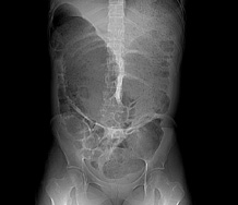 Niedrożność mechaniczna jelita grubego w przebiegu endometriozy - opis przypadku