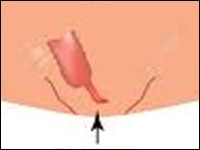 Prawostronna hemikolektomia z powodu rakowiaka wyrostka robaczkowego