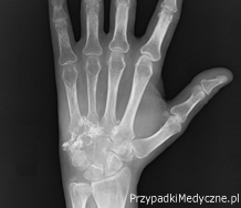 Chrzęstniakomięsak kości nadgarstka - opis przypadku