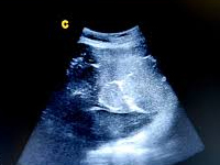 Ciąża powikłana nieprawidłowo zagnieżdżonym łożyskiem przodującym