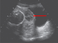 Łożysko wrośnięte u 19-letniej pierwiastki - opis przypadku