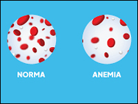 Kobieta w ciąży z ciężką niedokrwistością