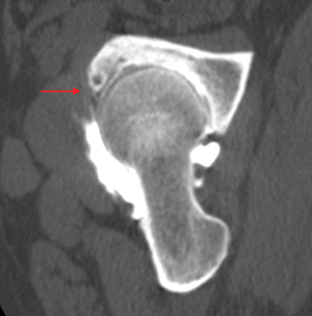Złamanie zmęczeniowe panewki stawu biodrowego