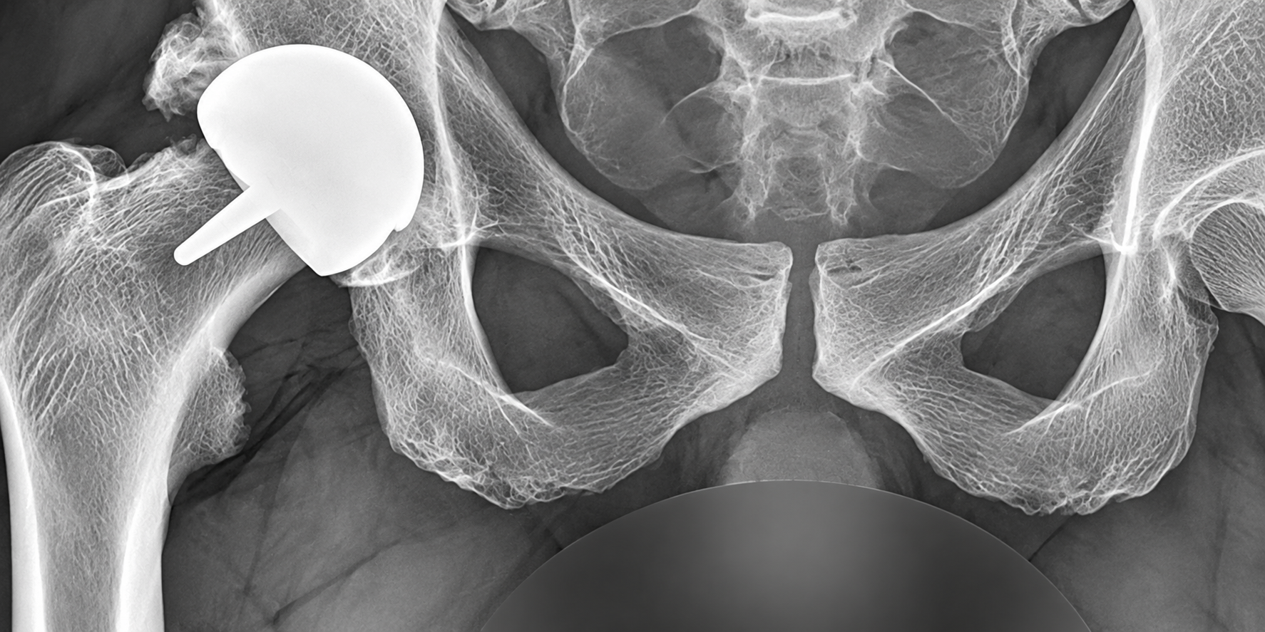 Hip resurfacing in an active patient – complicated course and long-term functional outcome: a case report